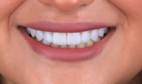 Depois - Dentes Amarelados